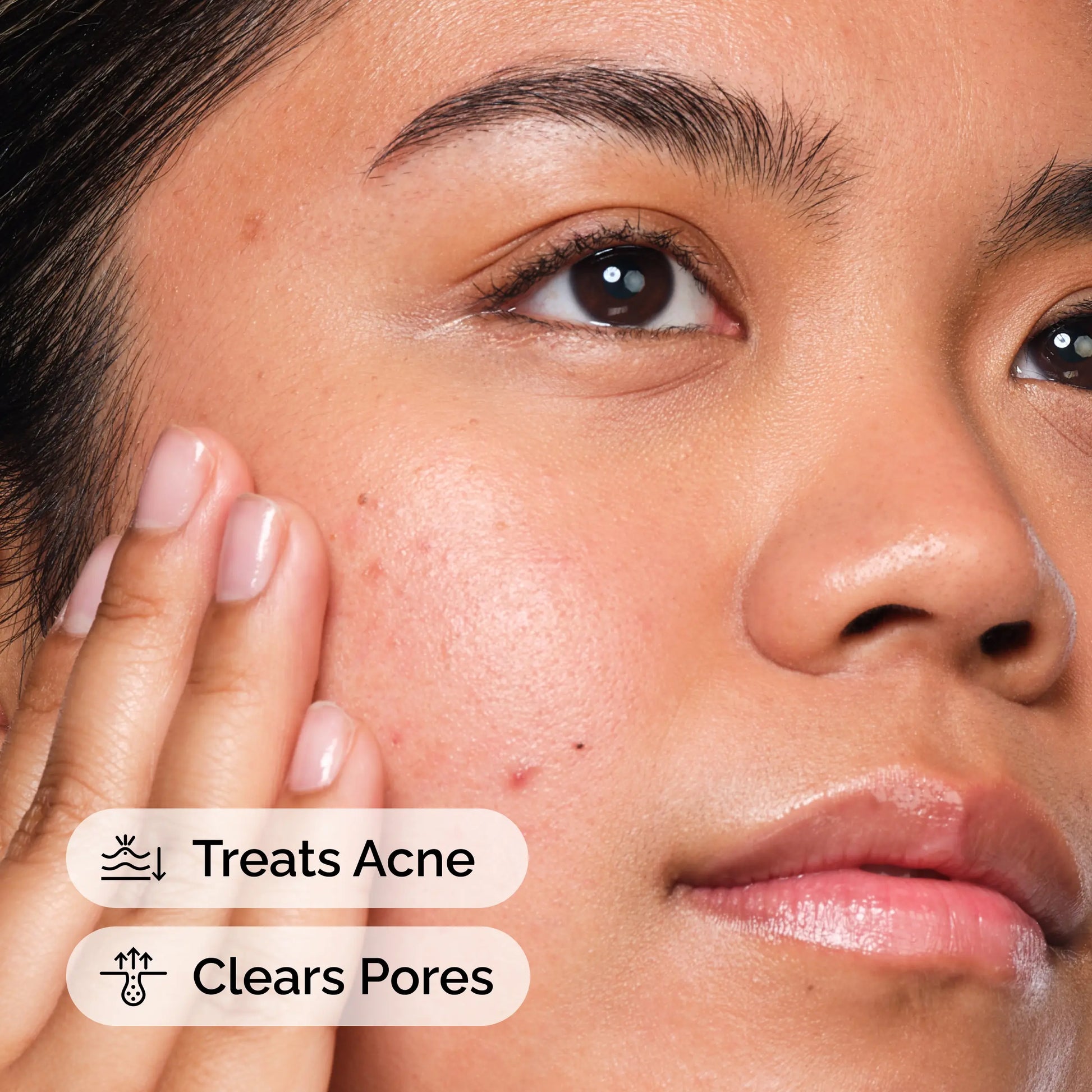 The Ordinary Salicylic Acid 2% Solution, Acne-Fighting Serum for Blemish-Prone Skin, 1 Fl Oz